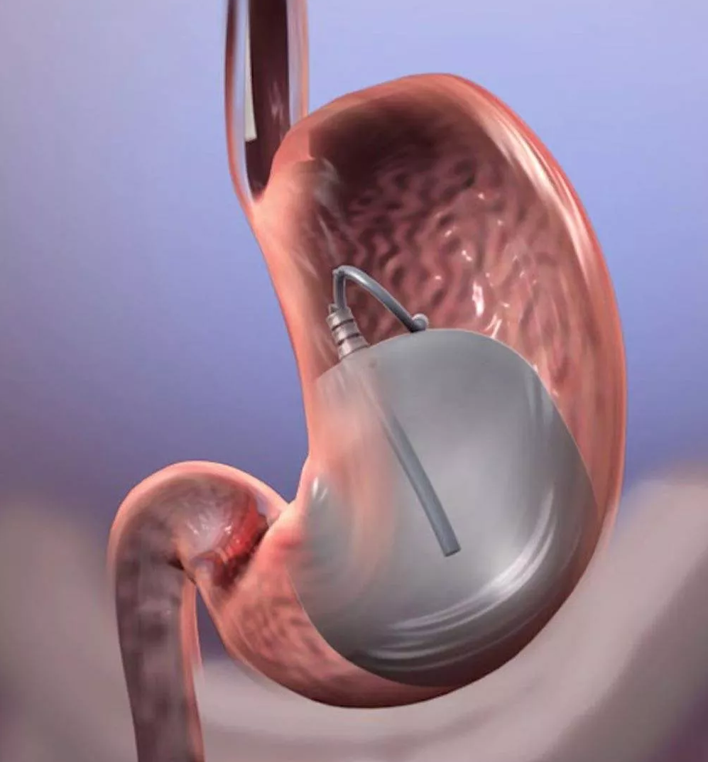 Balloon Endoscopy- Procedure, Risks and Results